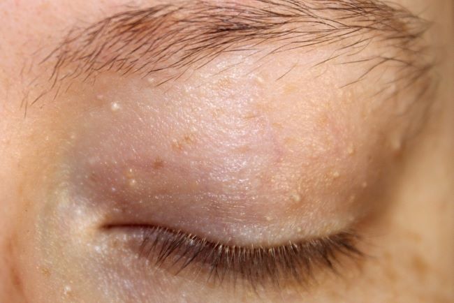 Milia di Mata, Kenali Penyebab dan Cara Mengatasinya - Alodokter