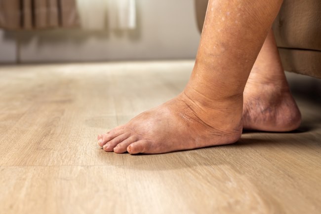 Ciri-Ciri Kaki Bengkak karena Jantung yang Perlu Diwaspadai - Alodokter