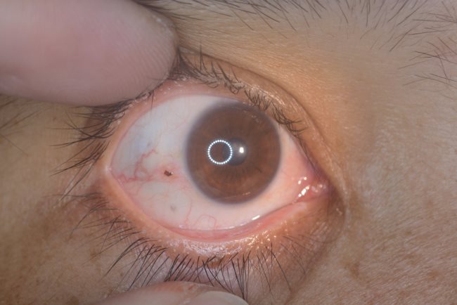 Corpus Alienum, Kondisi Ketika Benda Asing Masuk ke Dalam Tubuh - Alodokter