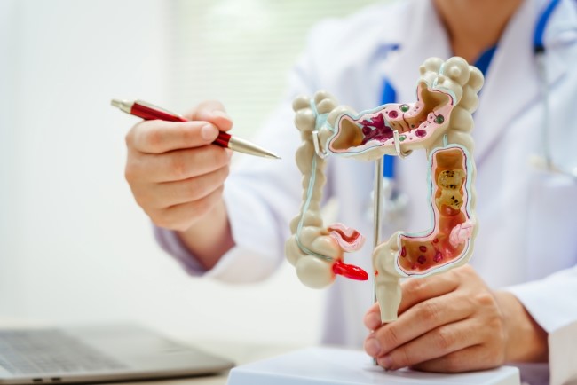 5 Gejala Kanker Usus Besar Stadium Awal yang Perlu Diwaspadai - Alodokter