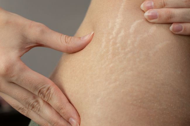 Apa Perbedaan Selulit dan Stretch Mark? Ini Penjelasannya! - Alodokter