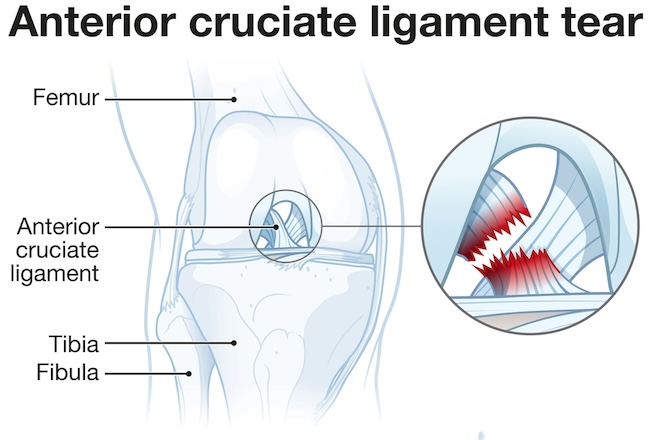 Ruptur ACL - patofisiologi, diagnosis, penatalaksanaan - Alomedika