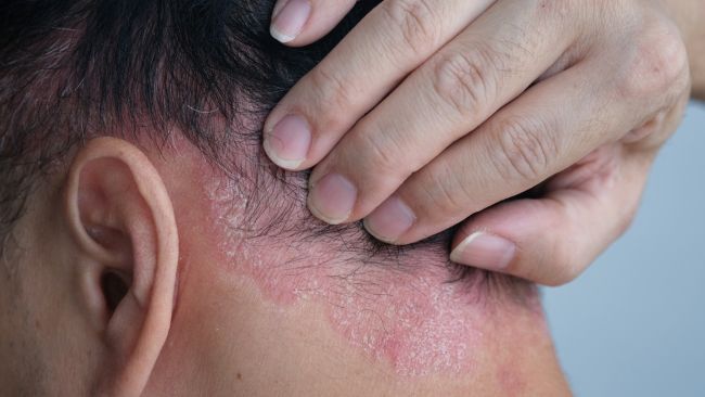 Apakah Dermatitis Seboroik Bisa Sembuh Sendiri? Ini Jawabannya! - Alodokter