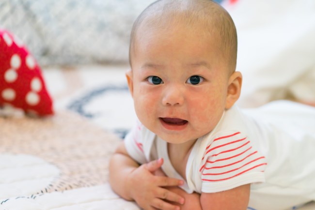 Agar Campak pada Bayi Cepat Keluar, Ini Cara Merawatnya - Alodokter