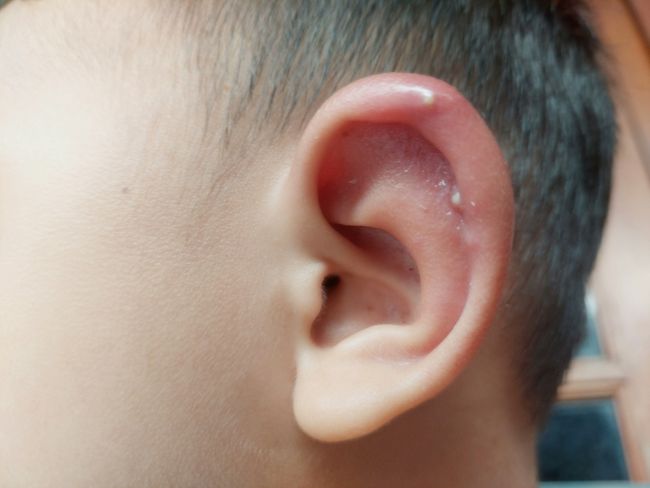 Bisul Di Telinga, Ketahui Penyebab, Cara Mengatasi, dan Pencegahannya - Alodokter