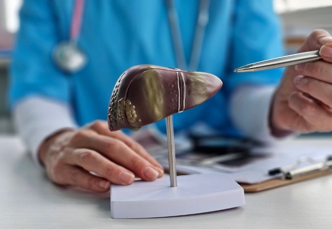 Fatty Liver Grade 2, Kenali Gejala, Penyebab, dan Cara Mengatasinya - Alodokter