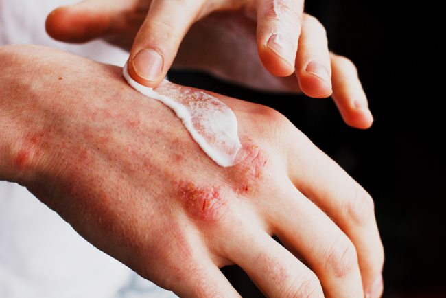 6 Obat Psoriasis yang Ampuh di Apotek - Alodokter