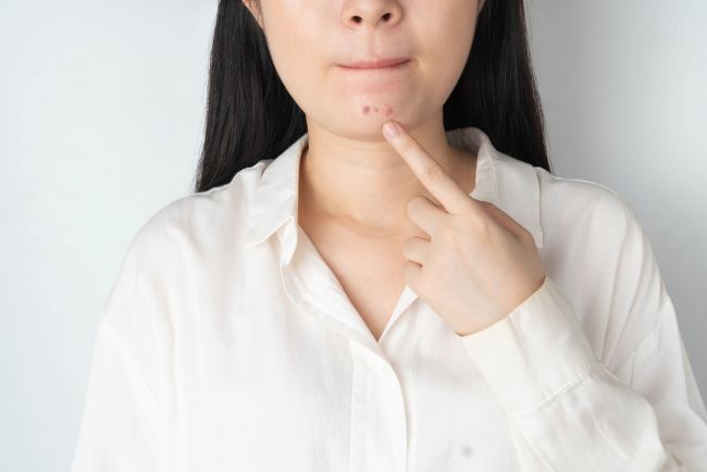 Berbagai Tanda Jerawat di Dagu yang Perlu Diketahui dan Cara Mengatasinya - Alodokter