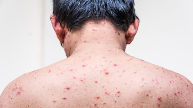 Apakah Cacar Air Boleh Mandi? Cek Informasinya di Sini - Alodokter
