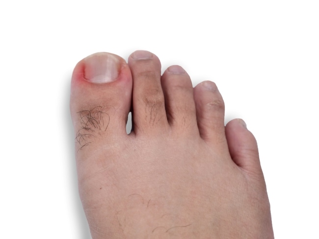 Cara Mengobati Cantengan yang Sudah Bengkak secara Aman di Rumah - Alodokter