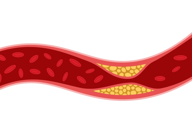 Penyumbatan Pembuluh Darah, Kenali Gejala dan Pengobatannya - Alodokter