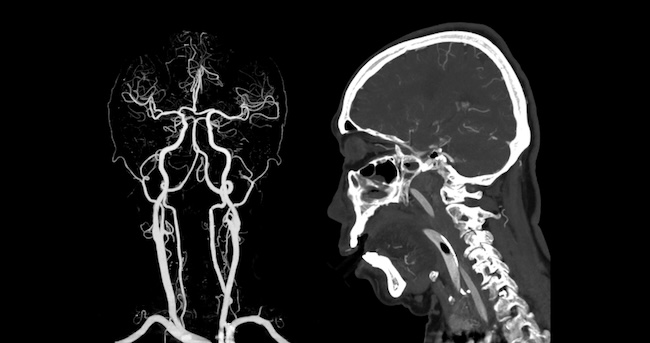 CT Angiografi Diperluas vs CT Angiografi Standar