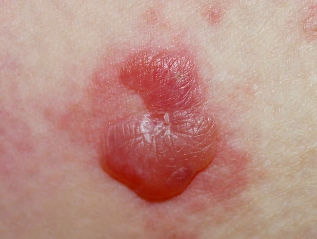 Pemfigoid Bulosa