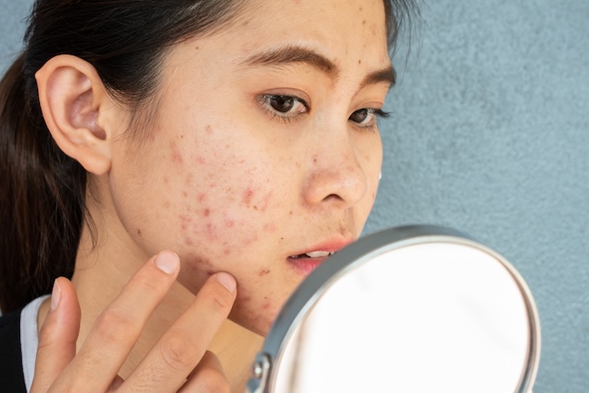 Tata Laksana Acne Vulgaris