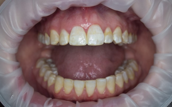 Fluorosis, Kenali Gejala, Penyebab, dan Penanganannya - Alodokter