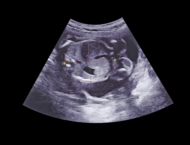 Begini Bentuk Janin 5 Bulan dan Tips Menjaganya agar Tetap Sehat - Alodokter