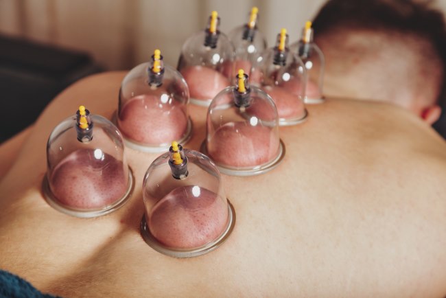 kop cupping therapy 