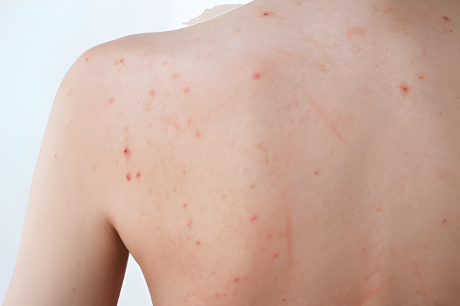 Jerawat di Badan, Ini Penyebab dan Cara Efektif Menghilangkannya - Alodokter