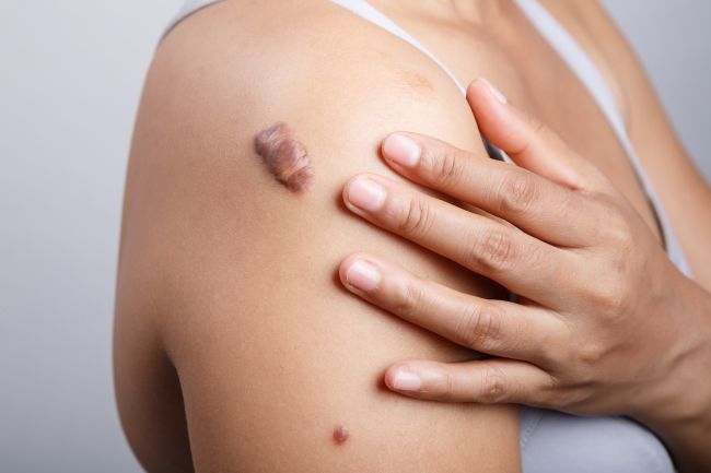 5 Ciri-Ciri Keloid Sudah Sembuh yang Perlu Diketahui - Alodokter