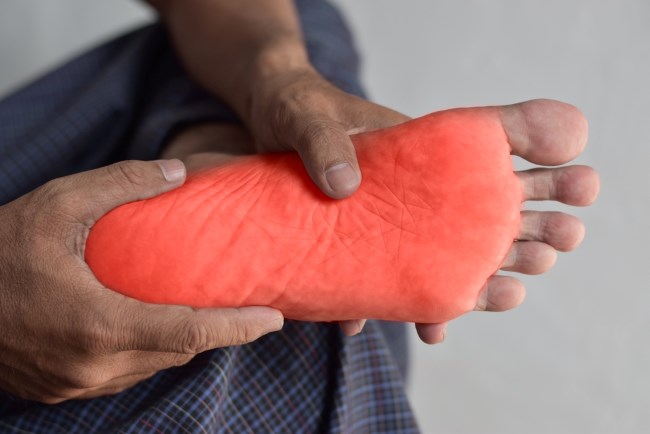 5 Cara Mengobati Telapak Kaki Terasa Panas yang Mudah dan Aman di Rumah - Alodokter