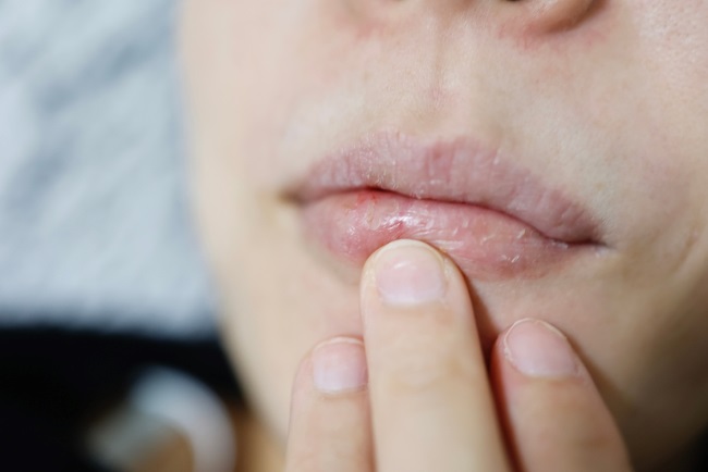 Kedutan Bibir Bawah, Ketahui Penyebab dan Tips Menanganinya - Alodokter