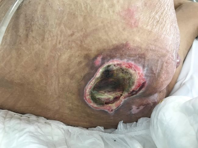 Penyebab Luka Diabetes Menghitam dan Tanda-Tandanya - Alodokter