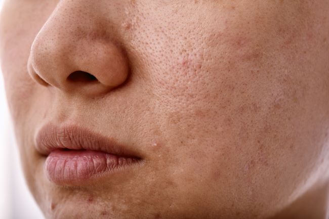 5 Perbedaan Fungal Acne dan Bruntusan yang Wajib Diketahui - Alodokter