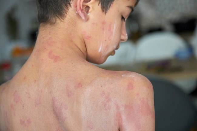 6 Pertolongan Pertama pada Anak Biduran yang Ampuh Redakan Gejala - Alodokter