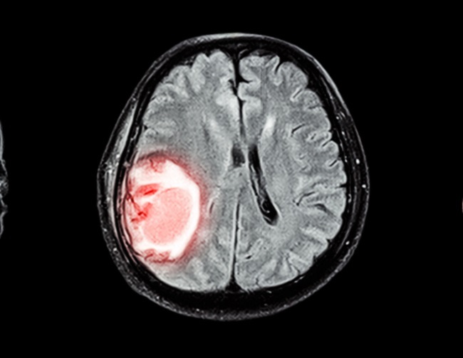 CT scan stroke hemoragik