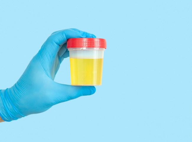 Risiko Infark Miokard Dan Stroke Setelah Infeksi Saluran Kemih Yang Terkonfirmasi