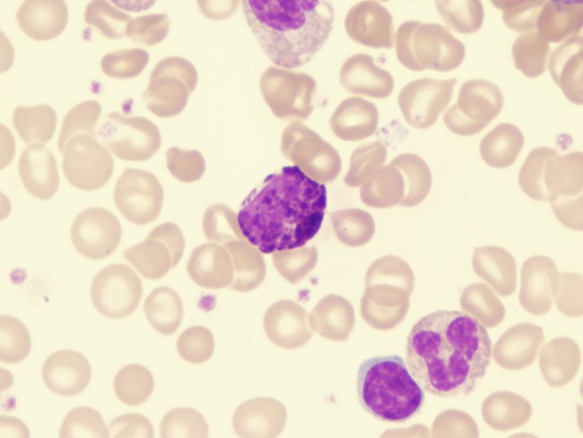 Basofil Tinggi, Inilah Penyebab dan Penanganannya - Alodokter