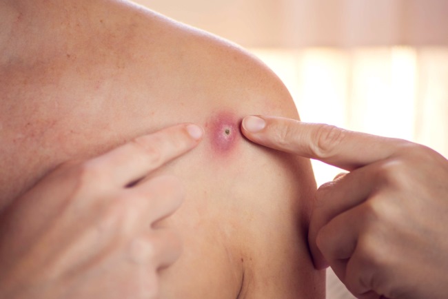 6 Cara Mencegah Bisul yang Mau Tumbuh - Alodokter