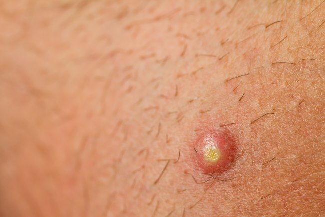 Apakah Bisul Menular? Ini Penjelasan dan Cara Mencegah Penularannya - Alodokter