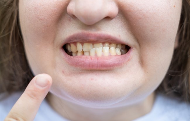 Rahang Miring, Ketahui Gejala, Penyebab, dan Penanganannya - Alodokter