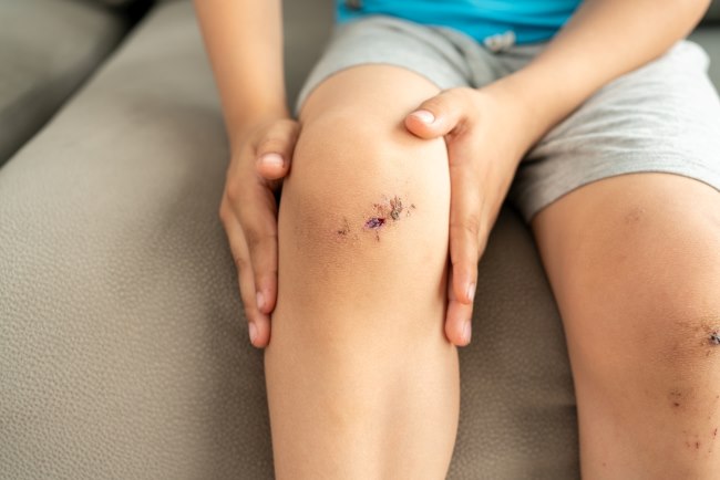 8 Salep Koreng yang Efektif dan Aman Digunakan - Alodokter