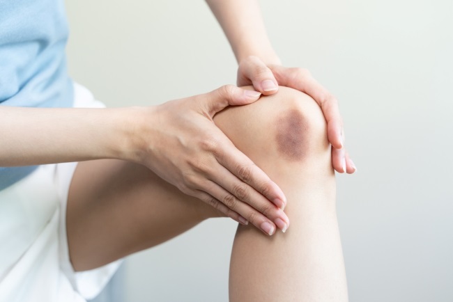 Lebam di Kaki, Ini Penyebab dan Cara Mengatasinya - Alodokter