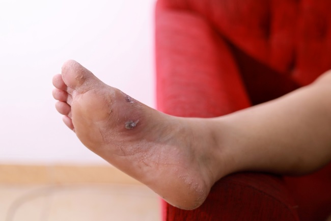 Ciri-Ciri Kaki Diabetes yang Harus Diwaspadai - Alodokter