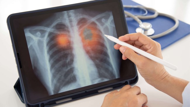 Flek Paru pada Anak, Kenali Penyebab, Gejala, dan Penanganannya - Alodokter