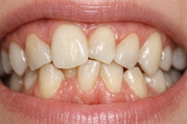 Gigi Bertumpuk, Ini Penyebab, Cara Merapikan, dan Dampaknya untuk Kesehatan - Alodokter