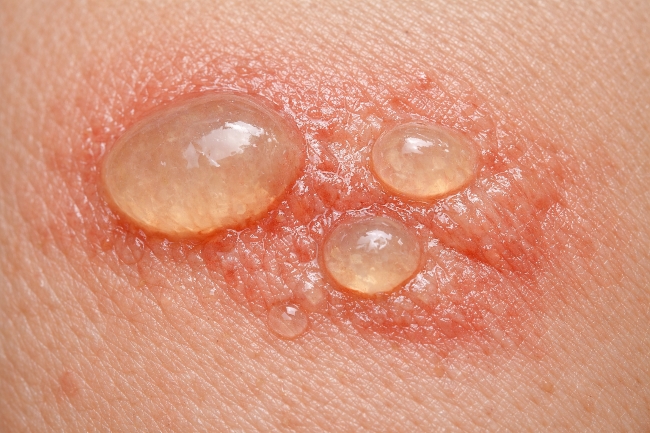 Luka Bakar Menggelembung dan Berair, Ini Penyebab, Risiko, dan Cara Merawatnya - Alodokter