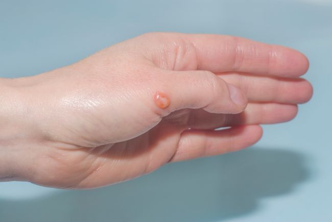 Gelembung Air pada Jari Tangan, Ketahui Penyebab dan Cara Mengatasinya - Alodokter