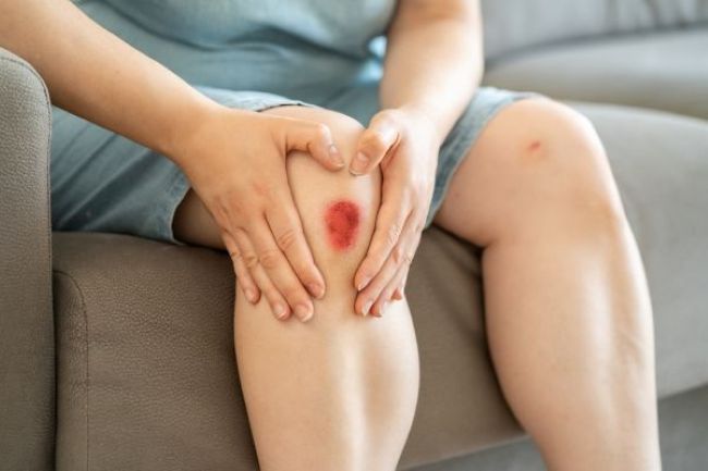 Cara Menghilangkan Perih pada Luka Lecet yang Aman Dilakukan - Alodokter