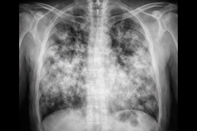 10 Kebiasaan yang Menyebabkan Paru-Paru Basah - Alodokter