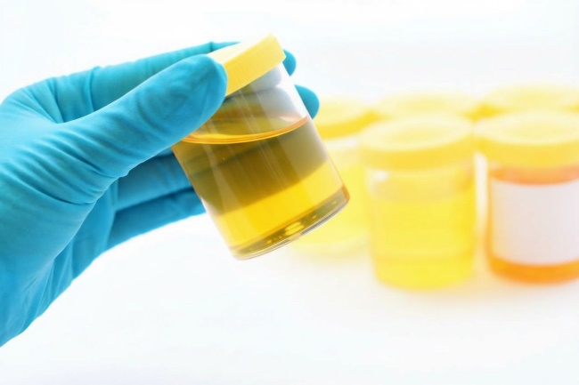 Mikroalbumin Urine, Pemeriksaan untuk Deteksi Dini Masalah Ginjal - Alodokter