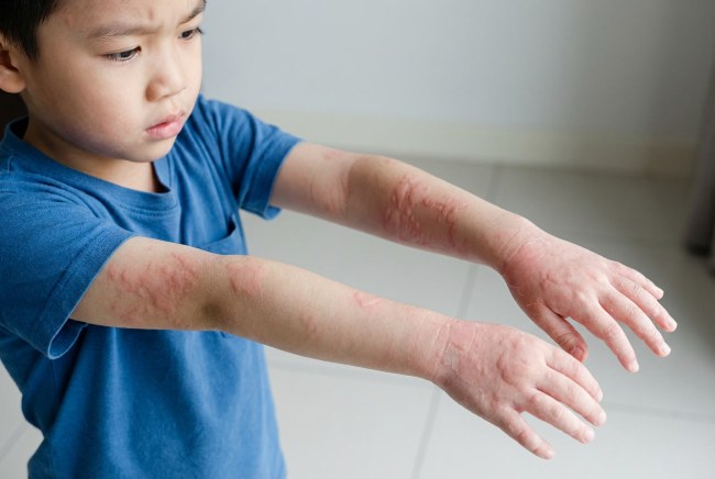 Kaligata pada Anak, Ini yang Perlu Diketahui Orang Tua - Alodokter