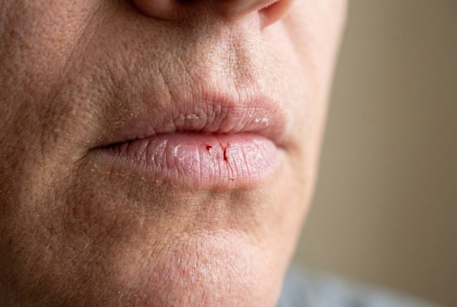 Bibir Berdarah, Ketahui Penyebab dan Cara Mengatasinya - Alodokter