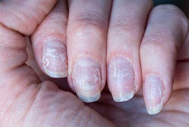 Ciri-Ciri Kuku Tidak Sehat yang Perlu Diwaspadai - Alodokter