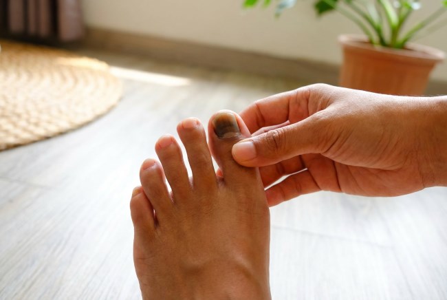 Kuku Mati, Inilah Penyebab dan Tips Perawatannya - Alodokter