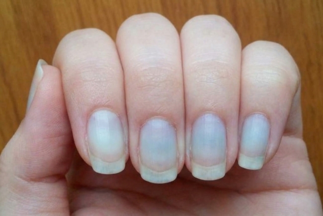 Kuku Biru, Kenali Penyebab dan Penanganannya - Alodokter