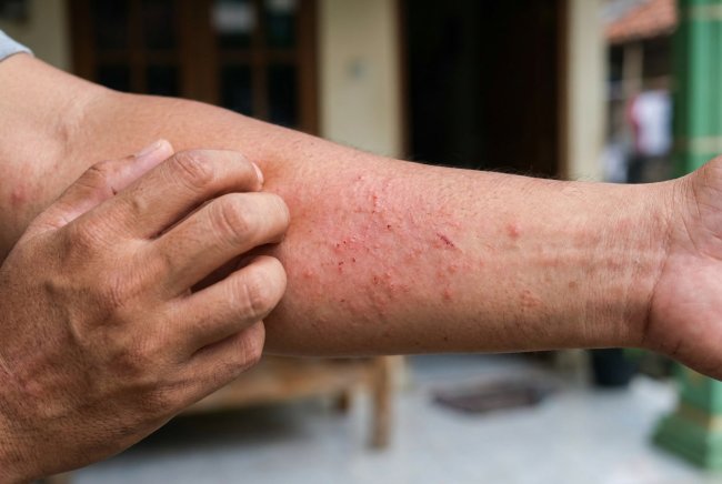 Kenali Perbedaan Gatal karena Ginjal dan Gatal Biasa - Alodokter